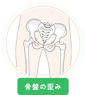 骨盤の歪み